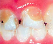 むし歯の写真1