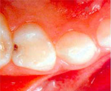 むし歯の写真2