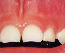 正常な歯の写真