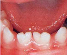 ゆ合歯の写真